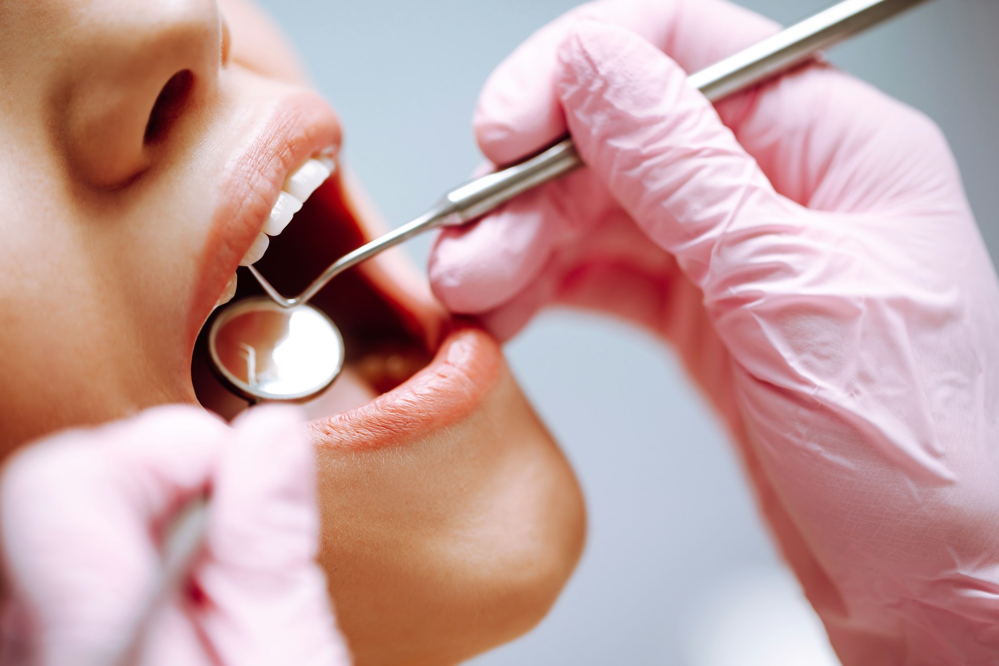 Young Woman At The Dentist S Chair During A Dental Procedure Overview Of Dental Caries Prevention .jpg